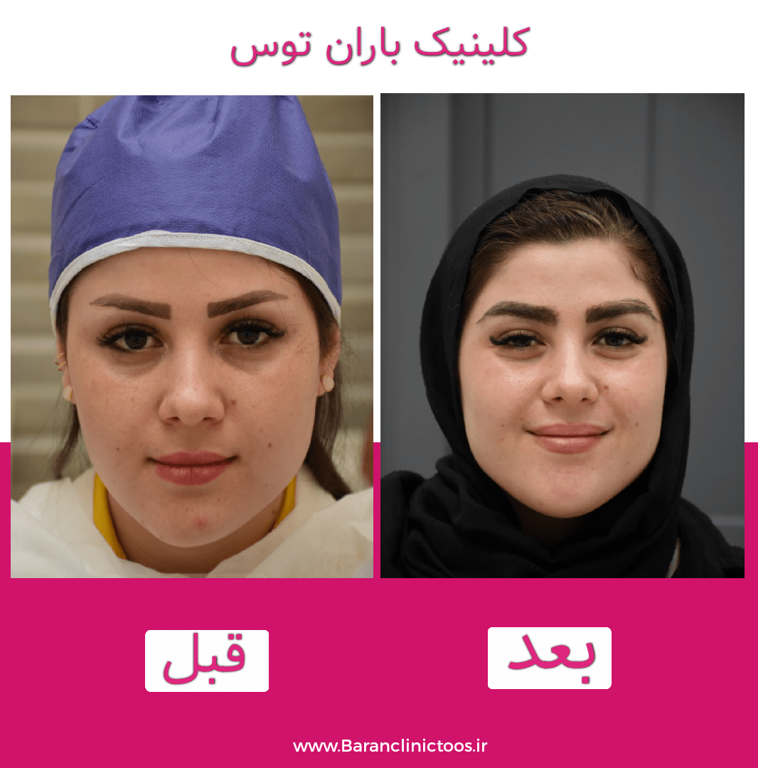 قبل و بعد کاشت ابرو